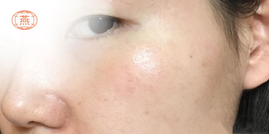 激光祛斑后能吃燕窝吗